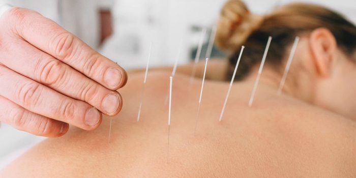 Acupuncture traditionnelle Comprendre ses principes
